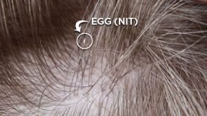 lice eggs or dandruff
